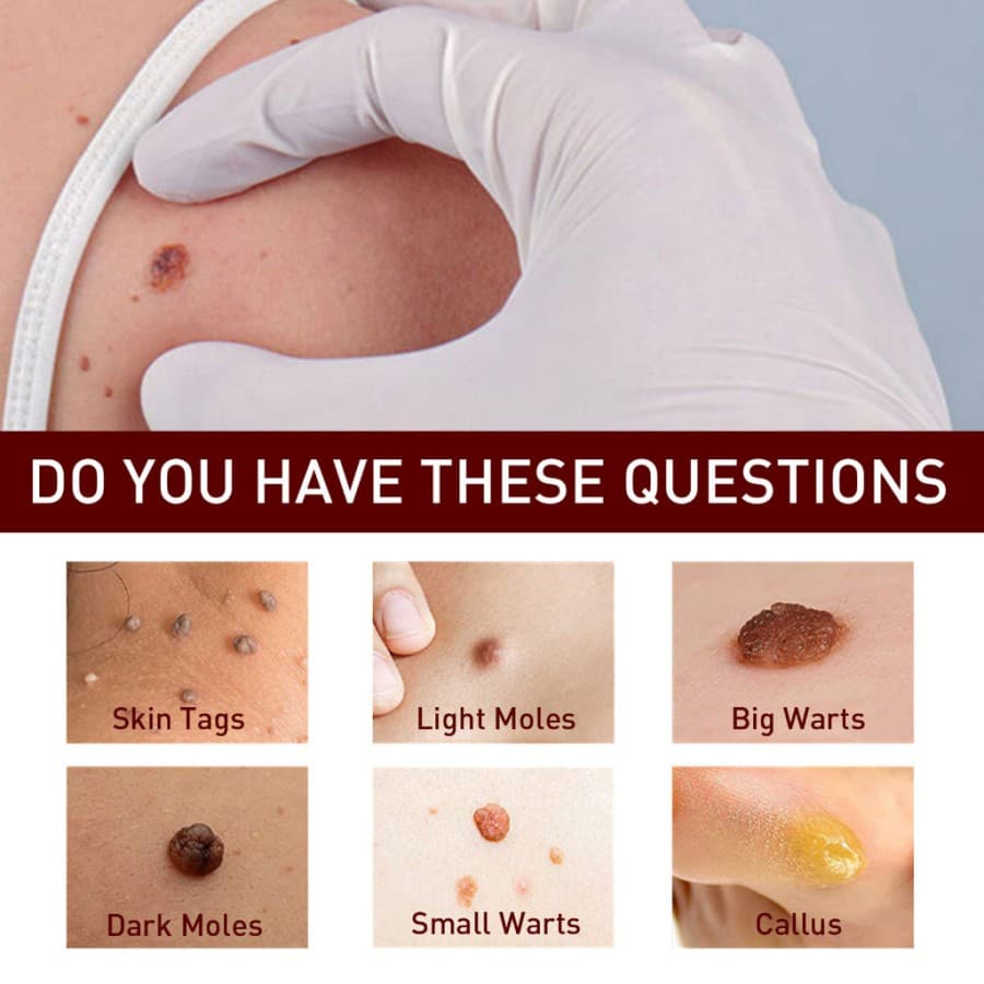 Gambar dari Tags & Moles Remover Krim Penghilang Kutil dan Tahi Lalat