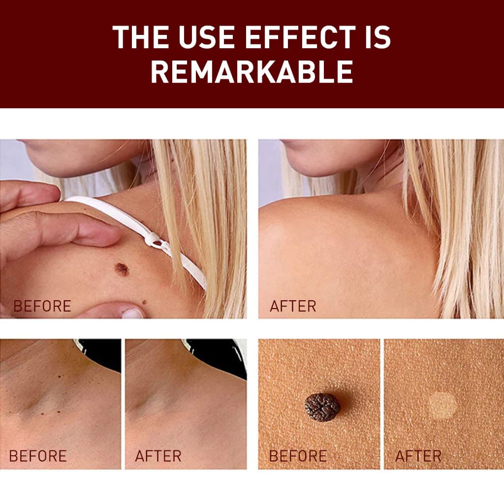 Gambar dari Tags & Moles Remover Krim Penghilang Kutil dan Tahi Lalat