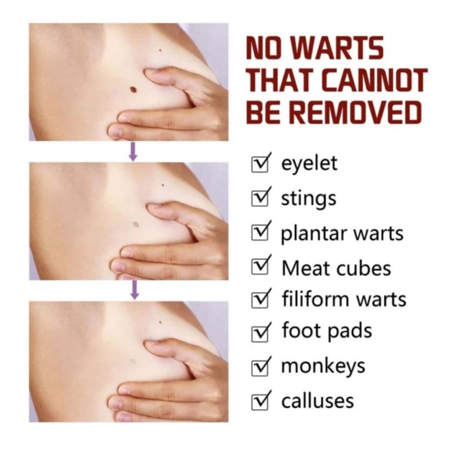 Gambar dari Tags & Moles Remover Krim Penghilang Kutil dan Tahi Lalat